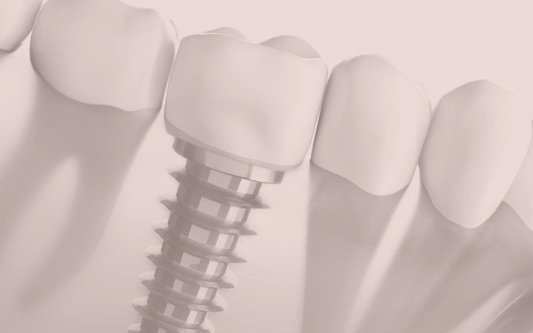Implante dental. Por qué reponer tus dientes si los pierdes