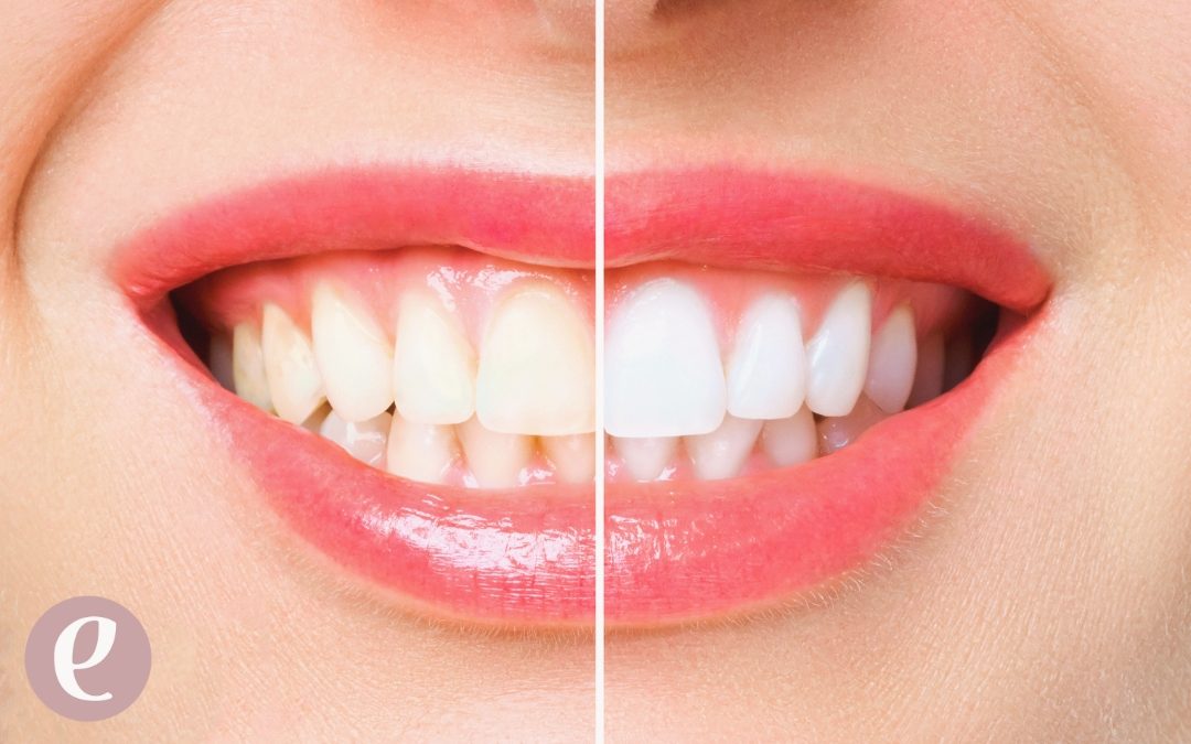 Blanqueamiento dental: beneficios de usar Philips Zoom frente a otros métodos